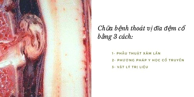 Phẫu thuật thoát vị đĩa đệm cột sống cổ