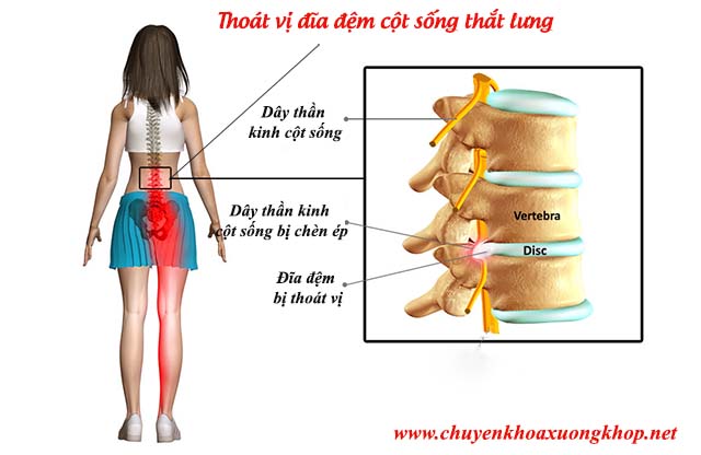 Thoát vị đĩa đệm cột sống thắt lưng