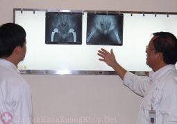 Xin bác sĩ tư vấn khi nào thì nên thay khớp háng ạ ?