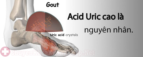 Acid uric cao kiêng ăn gì và nên ăn gì để đào thải acid uric?