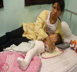 Bệnh viêm khớp háng ở trẻ em và những điều cha mẹ cần lưu ý