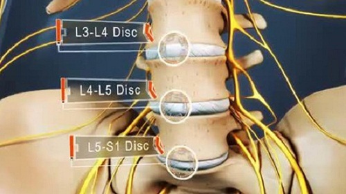 Tìm hiểu về bệnh thoát vị đĩa đệm cột sống thắt lưng l5 s1