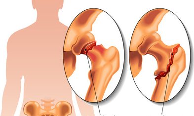 Các chấn thương khớp háng có thể dẫn đến tình trạng viêm khớp háng