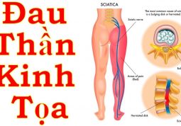 đau dây thần kinh tọa