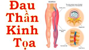 đau dây thần kinh tọa