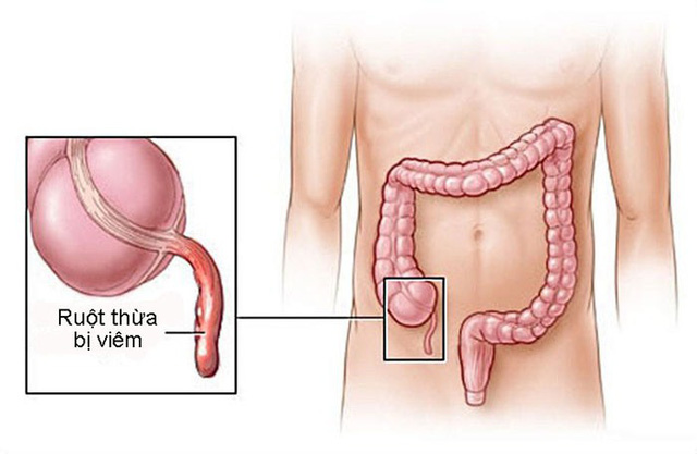 Vị trí ruột thừa và hình ảnh ruột thừa bị viêm