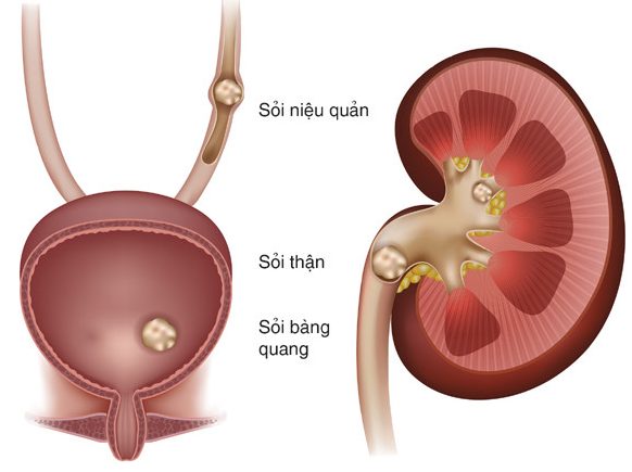 Sỏi thận có thể gây đau thắt lưng bên trái, bên phải hoặc cả hai bên tuỳ theo vị trí sỏi thận