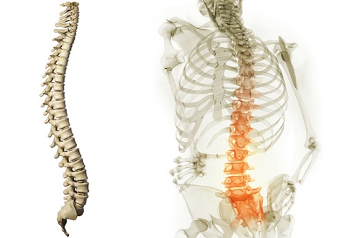 Thoái hóa cột sống thắt lưng dẫn đến đau thắt lưng