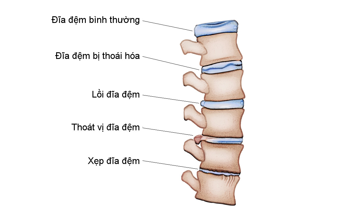 Thoát vị đĩa đệm và nhiều bệnh xương khớp có thể dẫn tới đau thắt lưng