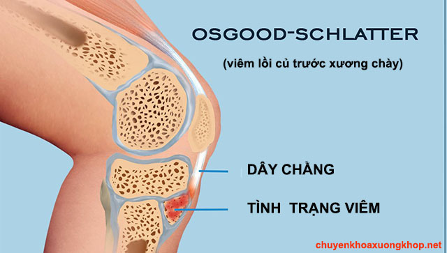 Osgood Schlatter gây đau đầu gối bên phải