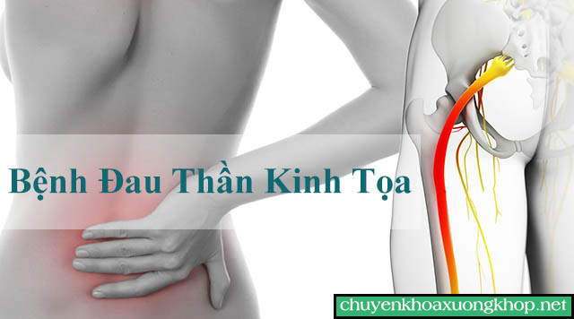 Đau dây thần kinh tọa - Biến chứng xuất hiện sau phẫu thuật thay khớp háng nhân tạo