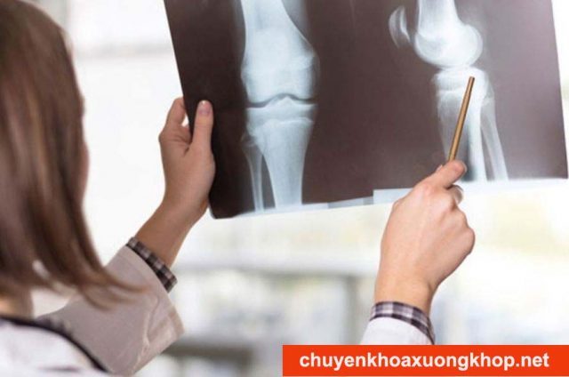 Gãy xương - Chấn thương đầu gối khi đá bóng