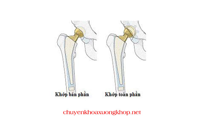 Khớp háng nhân tạo bán phần và toàn phần