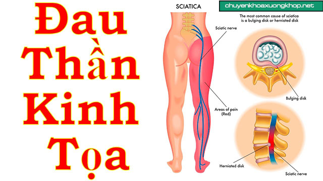 Thay khớp háng lần 2 do tổn thương dây thần kinh tọa