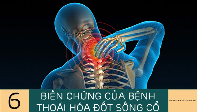 Biến chứng của bệnh thoái hóa đốt sống cổ vô cùng nguy hiểm