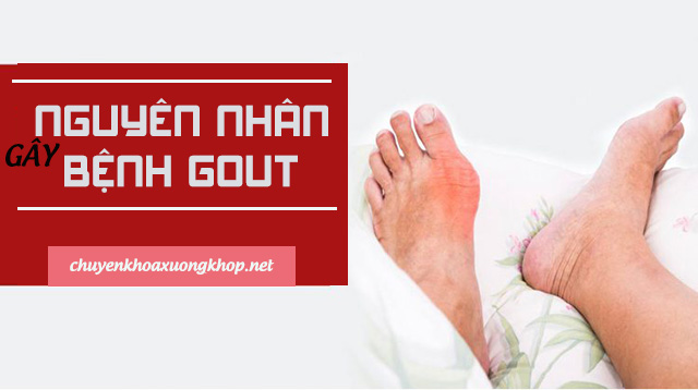 Những nguyên nhân chính gây ra bệnh Gout (gút - nguyên nhân bị bệnh gout