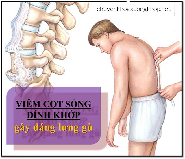 Triệu chứng viêm cột sống dính khớp