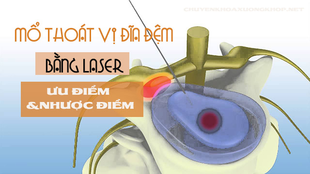 Mổ thoát vị đĩa đệm bằng Laser có ưu nhược điểm gì?