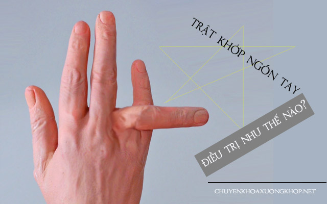 trật khớp ngón tay giữa Làm gì khi bị trật khớp ngón tay, bao lâu thì khỏi? trật khớp ngón tay cái
