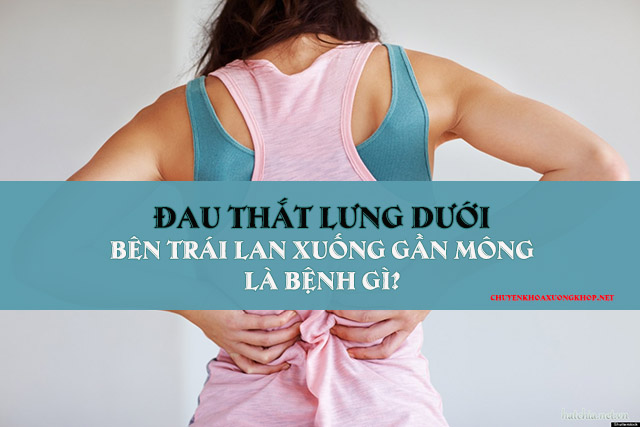 Bị đau thắt lưng dưới bên trái lan xuống gần mông