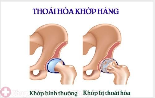 Điều trị thoái hóa khớp háng bằng bài thuốc Nhà thuốc Đỗ Minh Đường có thực sự hiệu quả?