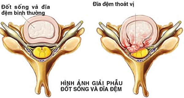 Điều trị thoát vị đĩa đệm bằng bài thuốc dân gian có hiệu quả