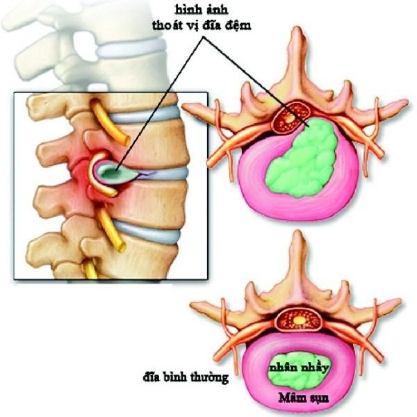 Thoát vị đĩa đệm