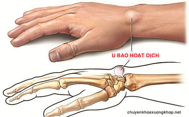 U bao hoạt dịch khớp cổ tay