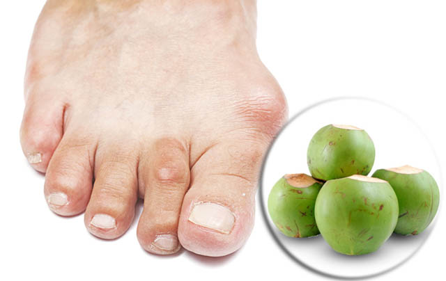 chữa bệnh Gout bằng dừa xiêm