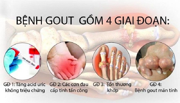 Các giai đoạn bệnh gout