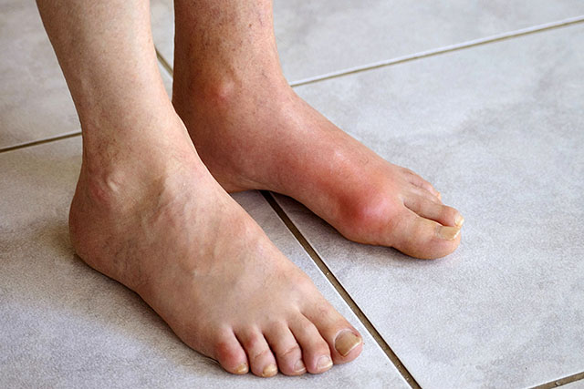 Bị bệnh Gout có chữa khỏi được không Bị bệnh Gout có chữa khỏi được không