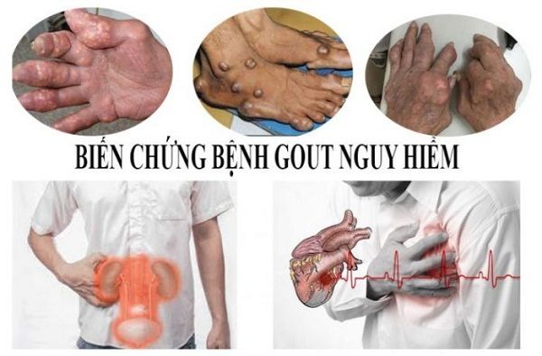 Biến chứng khủng khiếp do bệnh gout